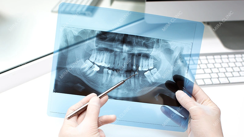 Root canal treatment